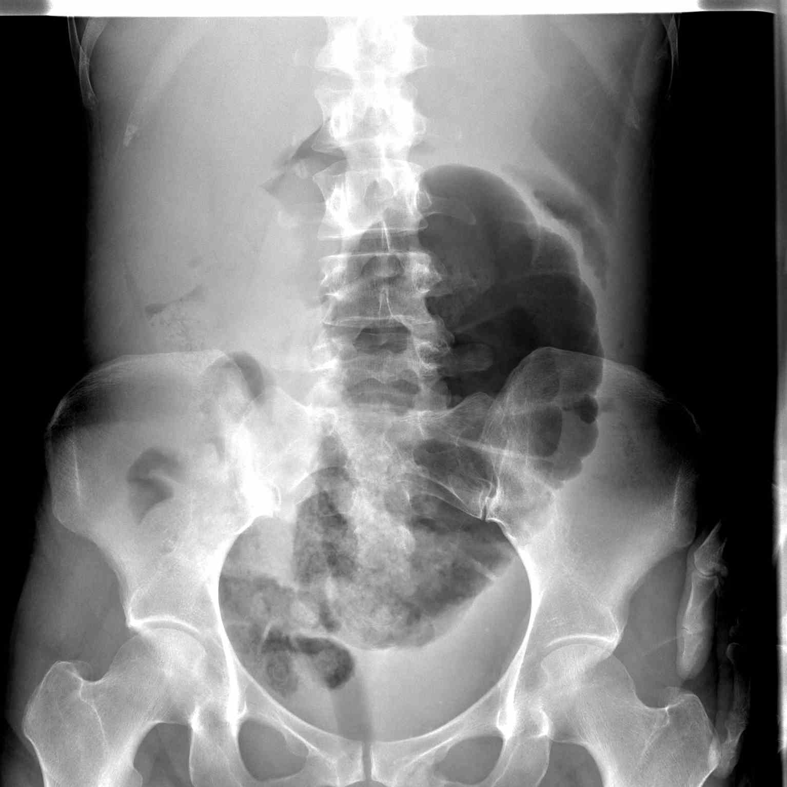 <p>Cecal Volvulus Radiograph. The image is the anteroposterior abdomen&nbsp;as seen on a radiograph.</p>