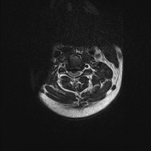 <p>Cervical Spine MRI.&nbsp;Axial view of a herniated disc&nbsp;in the cervical region.</p>