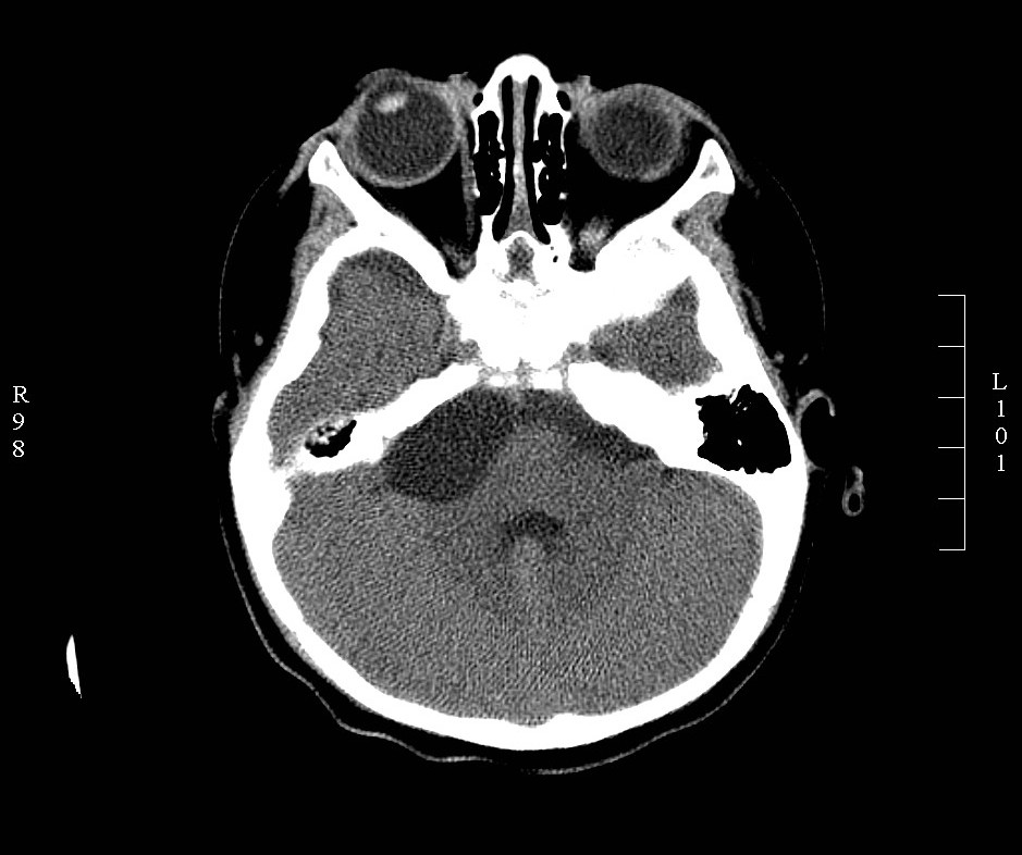 <p>Arachnoid Cyst. Head CT, cerebellopontine angle&nbsp;(CPA) of an arachnoid cyst.</p>