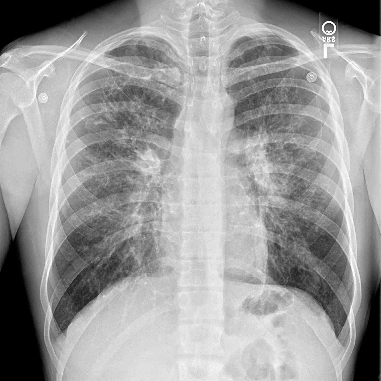 <p>Periapical Chest Radiograph, Cystic Fibrosis</p>