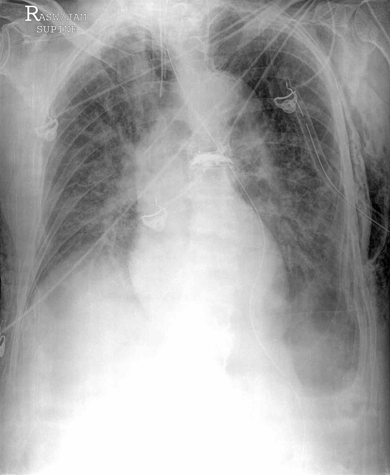 <p>Portable Chest Radiograph, Left Deep Sulcus Pneumothorax</p>