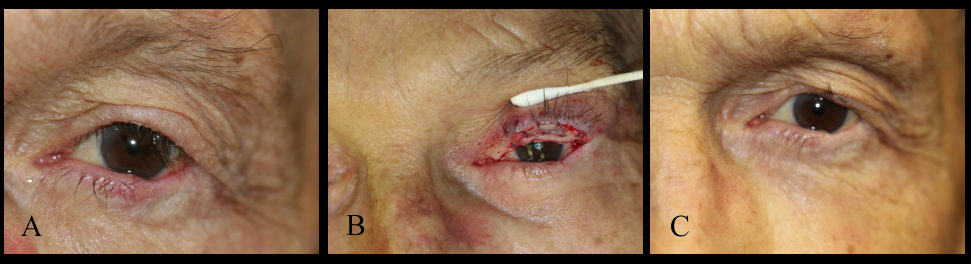 Repair of trachomatous upper eyelid entropion with Trabut-type eversion and use of mucous membrane graft