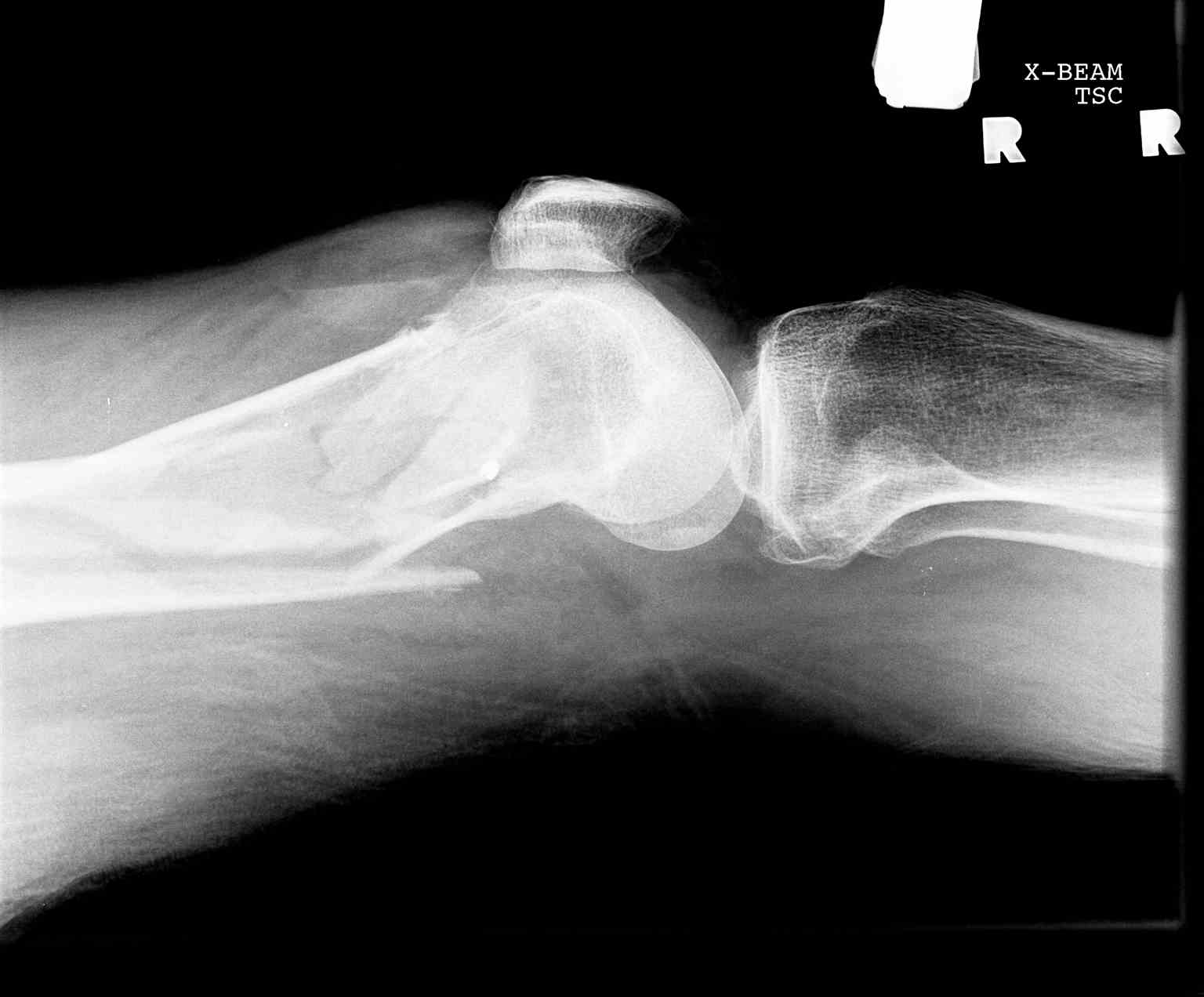 <p>Lateral Knee Radiograph, Fracture With Lipohemarthrosis</p>