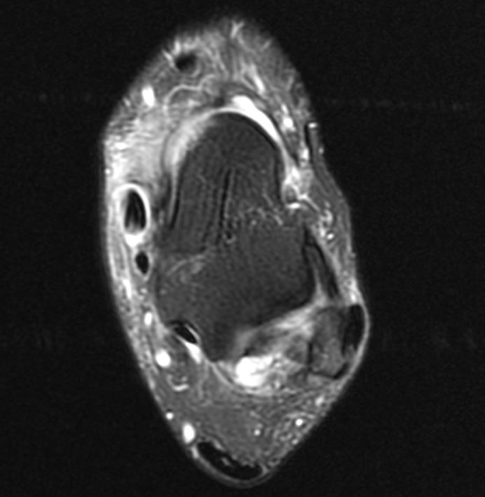 Posterior Tibial Tendon Dysfunction- MRI demonstrating extensive tenosynovitis of the posterior tibial tendon (PTT)
