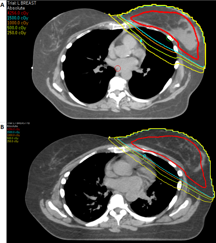 A comparison of the dose received by the left anterior descending artery (smallest circle in blue at the edge of the mediastinum) between a patient simulated in deep-inspiration breath-hold position vs