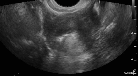 Sonohysterosalpingogram showing patent fallopian tube (hyper-echoic bubbles seen flowing through the cornua and outside of th