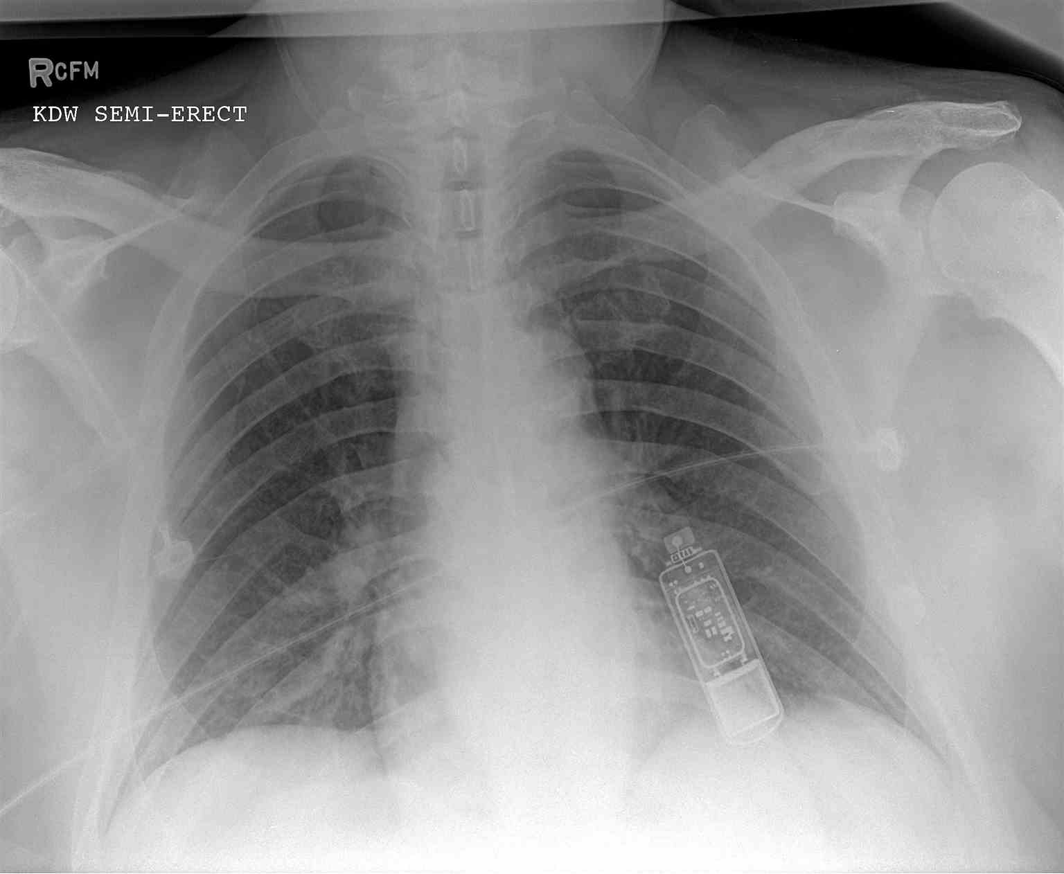 <p>Chest Radiography. PA Chest Radiograph reveals Implantable Loop Recorder.</p>