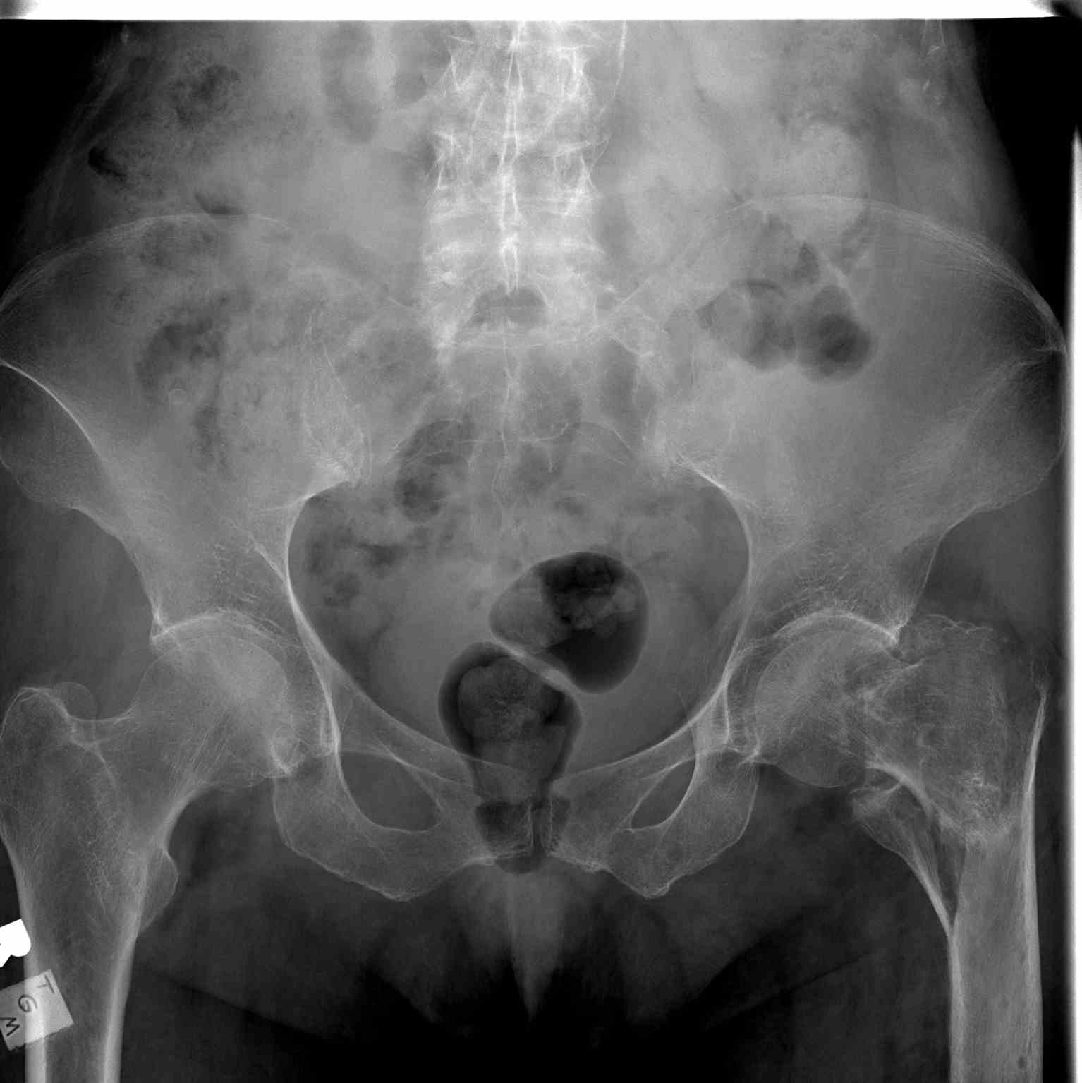 <p>Pelvic Radiograph, Left Hip Fracture</p>