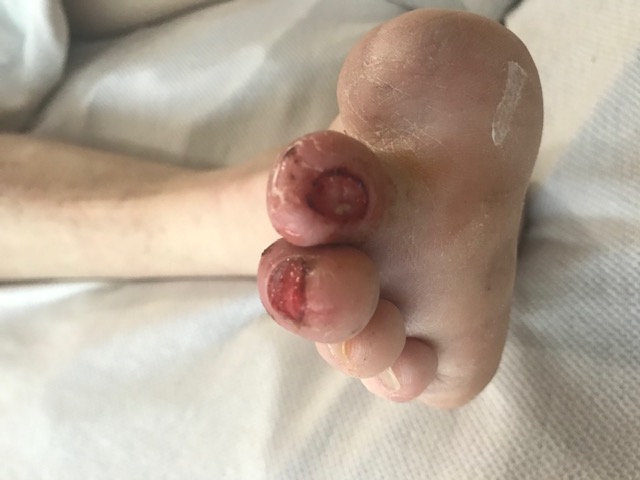 <p>Neuropathic Ulcerations in a Patient With Diabetes. Note the prior hallux amputation</p>