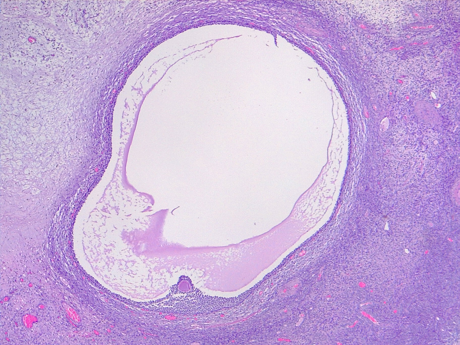 Ovarian follicle in maturation, cystic mature follicle.
