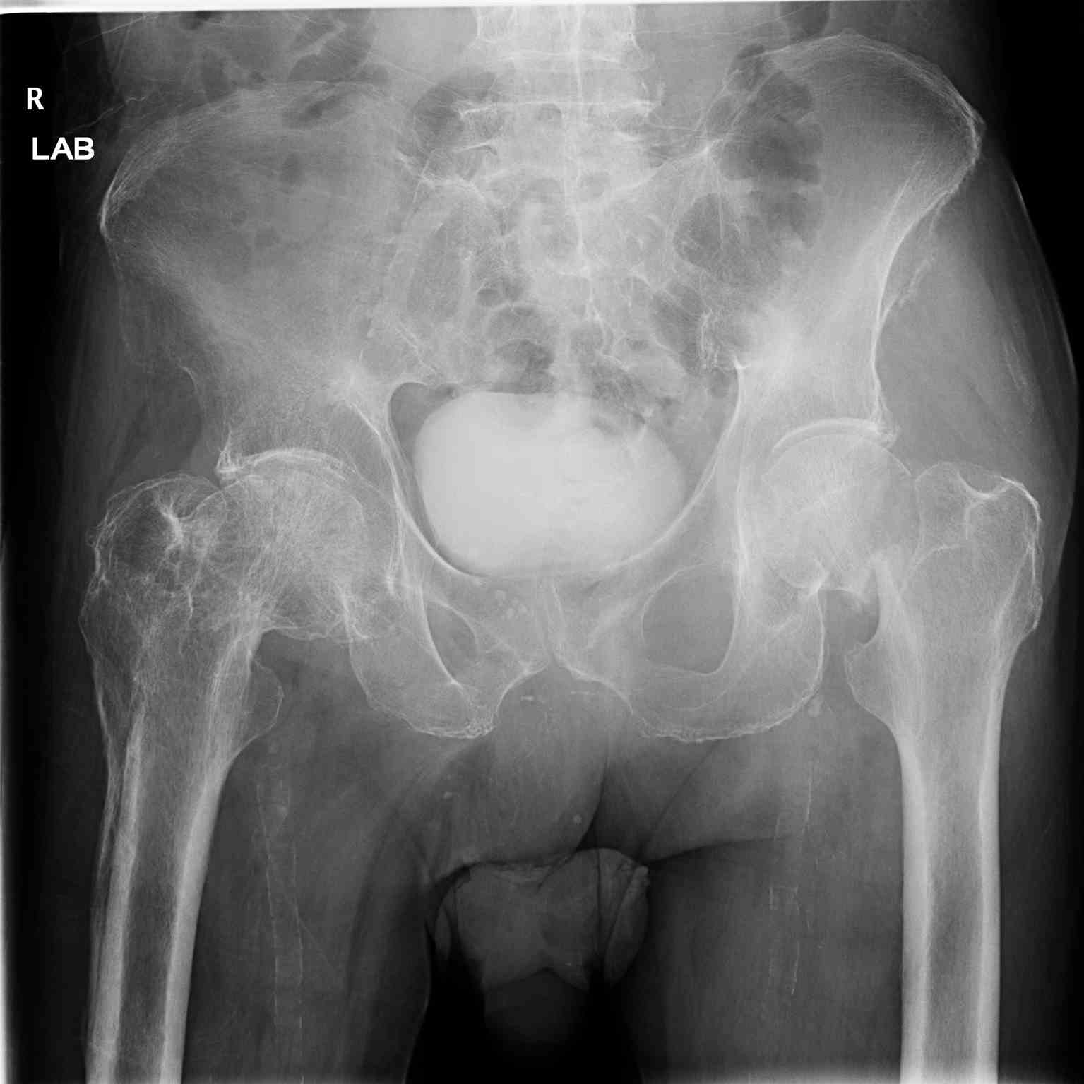 <p>Pelvic Radiograph, Right Hip Fracture</p>