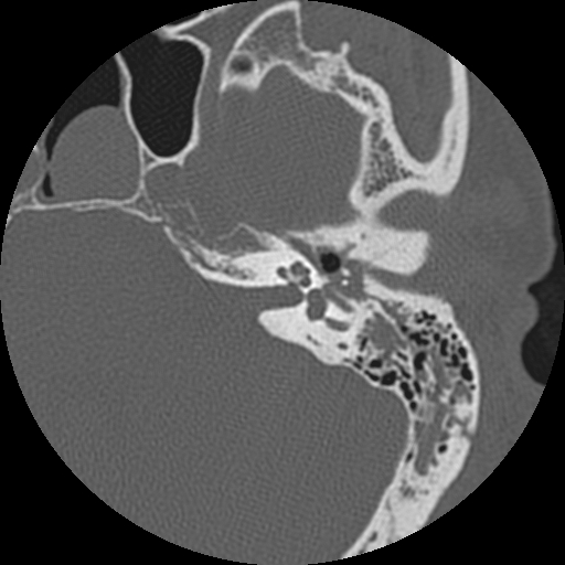 <p>Temporal Bone Fracture Computed Tomography. This image shows a left-sided temporal bone fracture.</p>