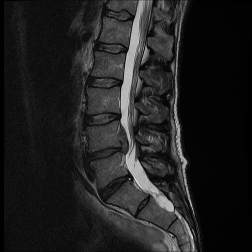 <p>Lumbar Spine MRI, Disc Extrusion</p>
