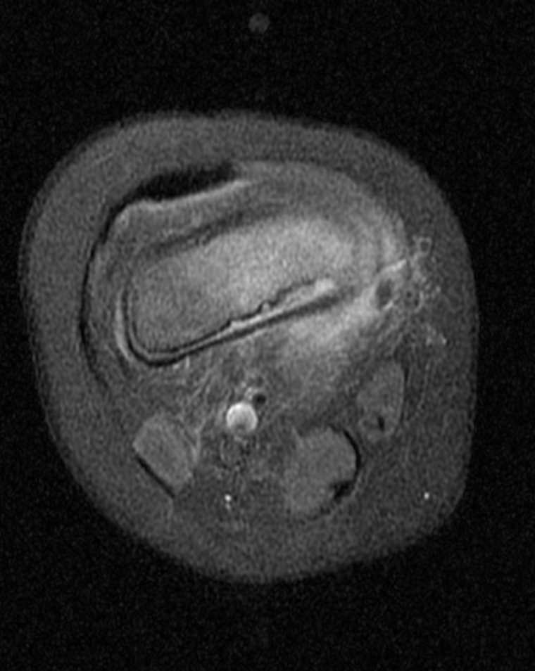 <p>MRI T1-Weighted Postcontrast Knee Osteomyelitis</p>