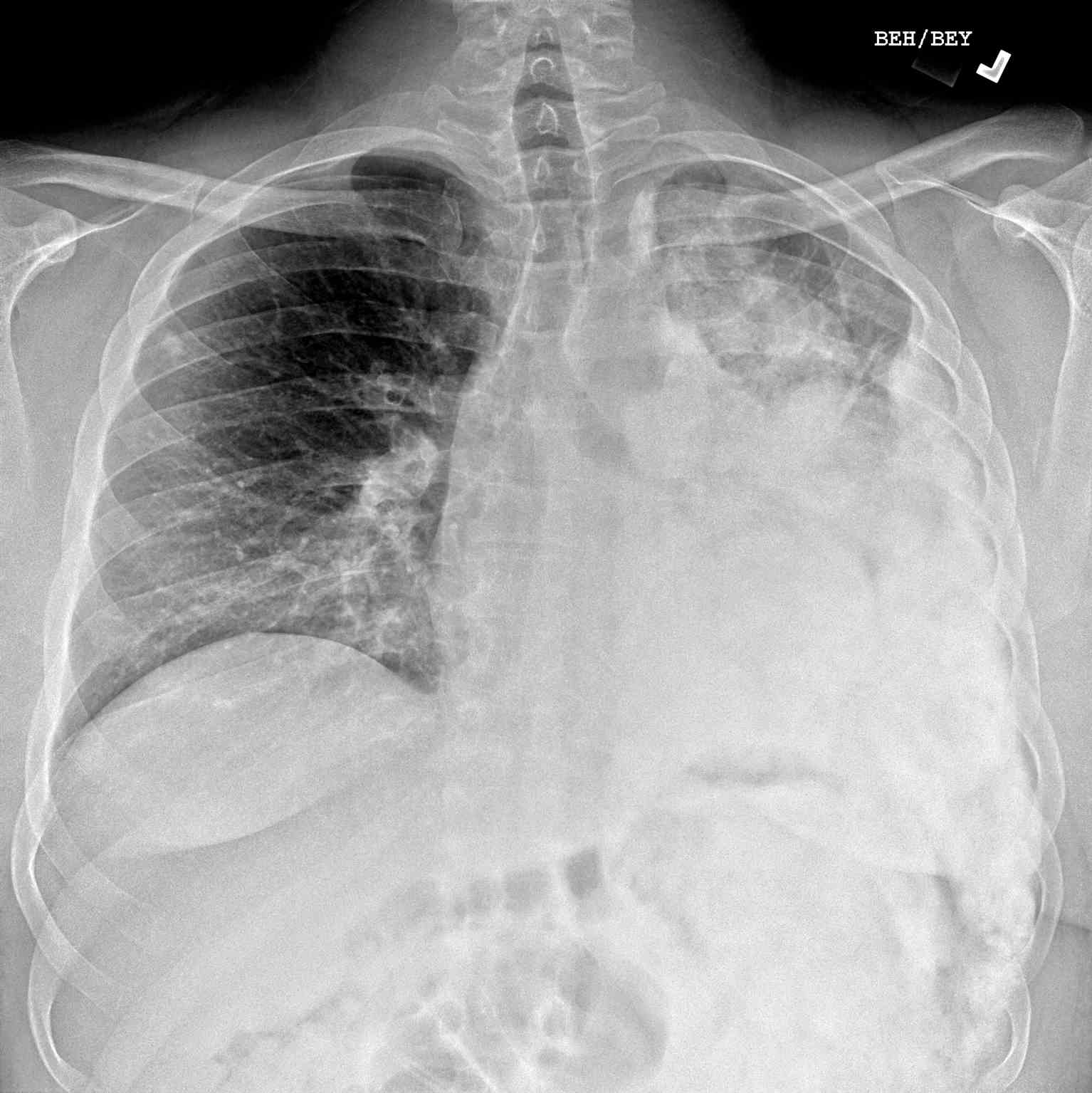 <p>Pulmonary Metastasis of Osteogenic Sarcoma. Chest x-ray demonstrating metastasis of osteosarcoma to the lung.</p>