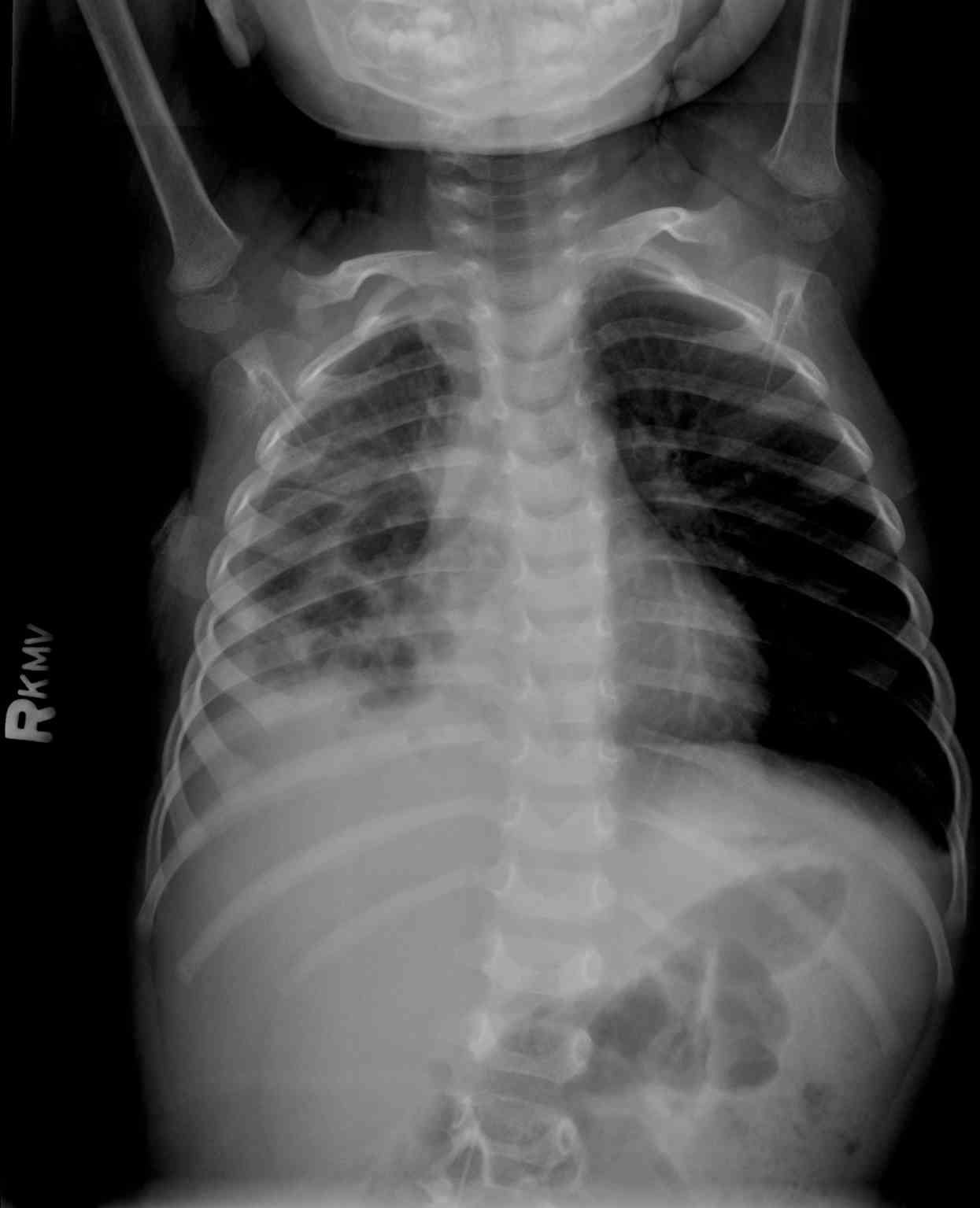 <p>Chest Radiograph, Pneumatoceles Pneumonia</p>