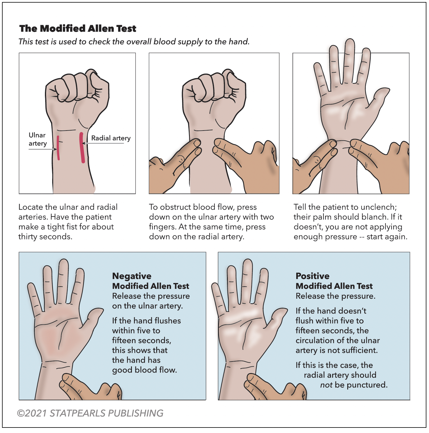 <p>Modified Allen Test. This test is used to check the overall blood supply to the hand.</p>