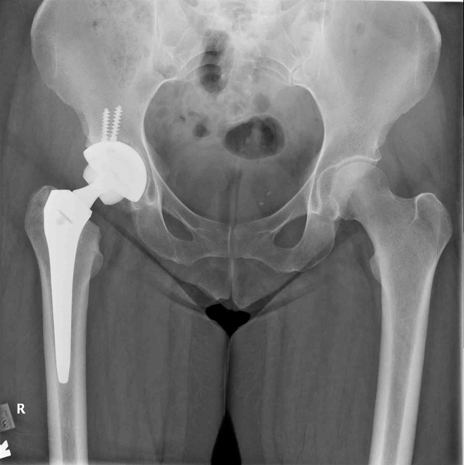 <p>Pelvic Radiograph, Right Hip Arthroplasty</p>