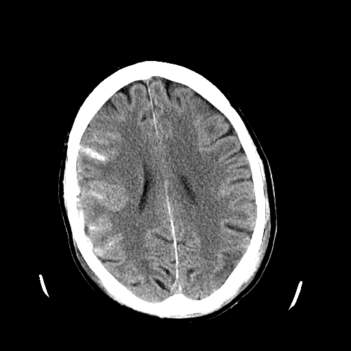 <p>Head CT Revealing Subarachnoid Hemorrhage
