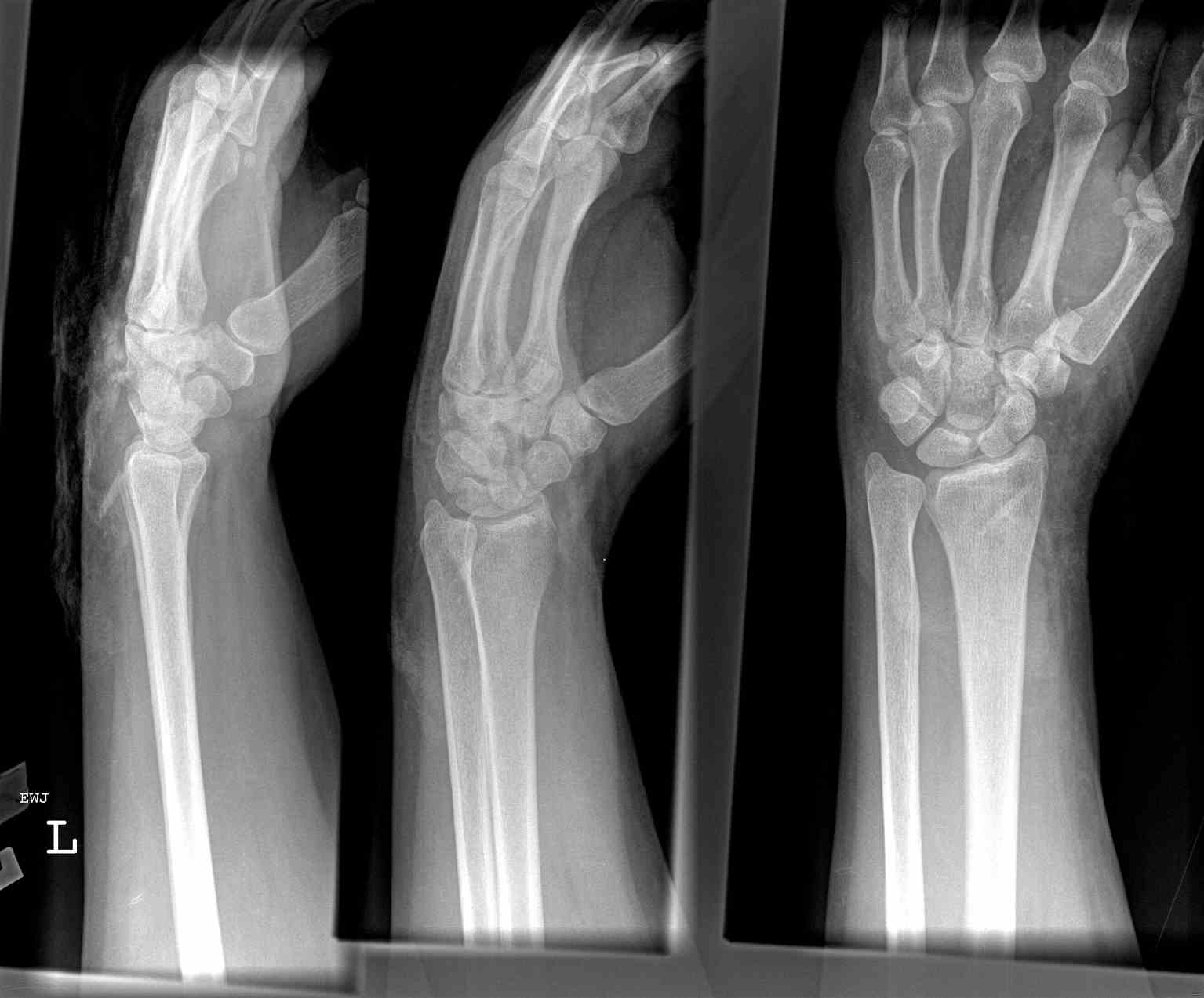 <p>Wrist Radiograph, Scaphoid Fracture</p>