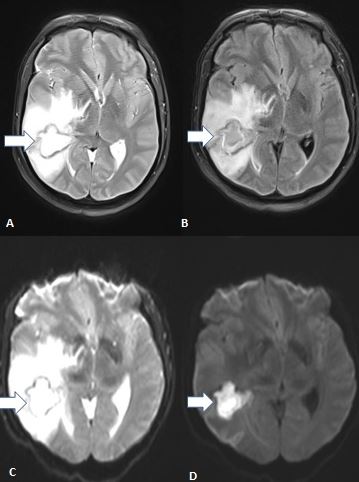 <p>Brain Tuberculoma on Magnetic Resonance Imaging</p>