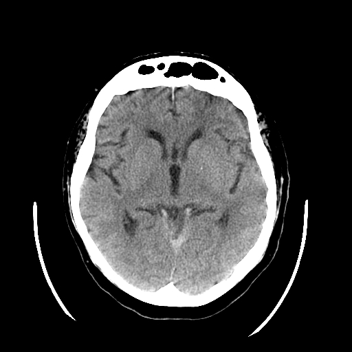<p>Head CT, Subdural Hematoma Tentorium</p>
