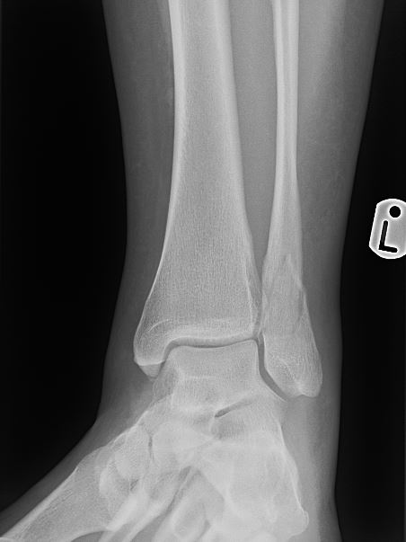 AP x-ray showing left ankle weber B fracture.