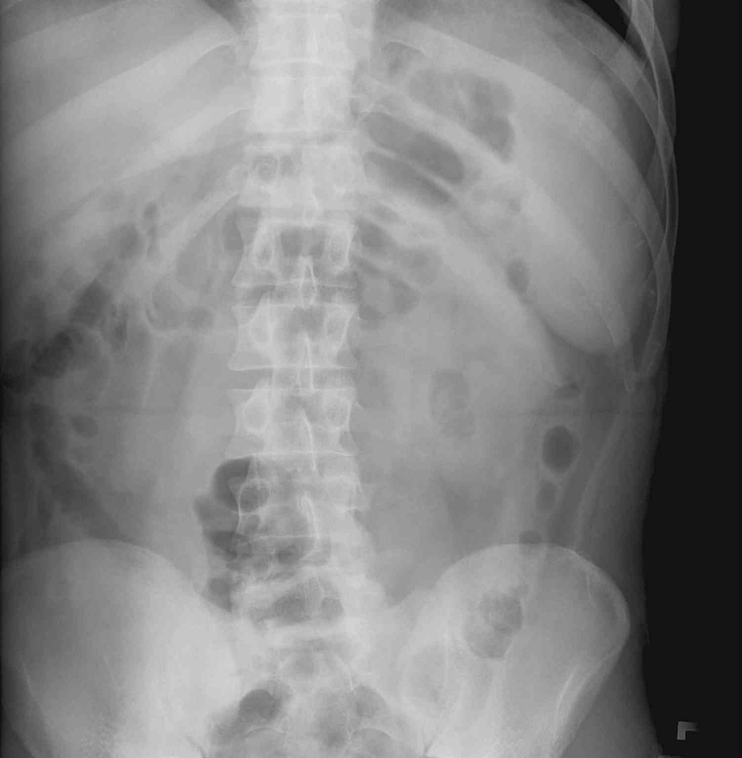 <p>Abdominal Radiograph of Splenomegaly. Splenomegaly is visualized on an abdominal x-ray.</p>
