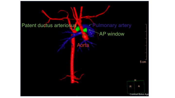 <p>CT Scan, 3D Reconstruction Demonstrating an Aortopulmonary Window