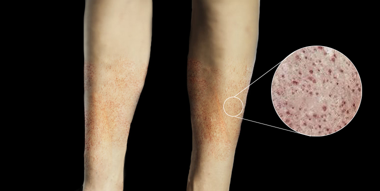 <p>Petechiae. Close-up image showing petechiae scattered over the legs.</p>