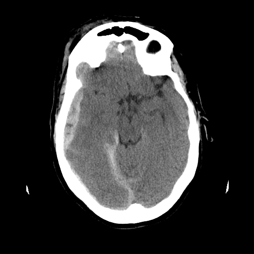 <p>Head CT,&nbsp;Subdural Hematoma</p>