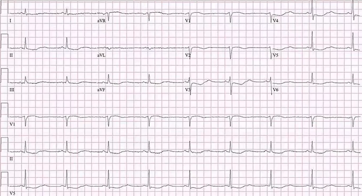 <p>ECG in a Patient With Hypokalemia