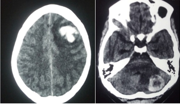 <p>Choriocarcinoma Metastasis to Brain</p>