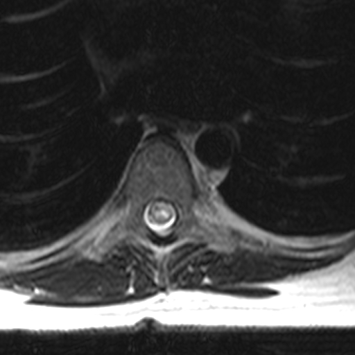 <p>Spine MRI,&nbsp;T2 Axial Transverse Myelitis</p>