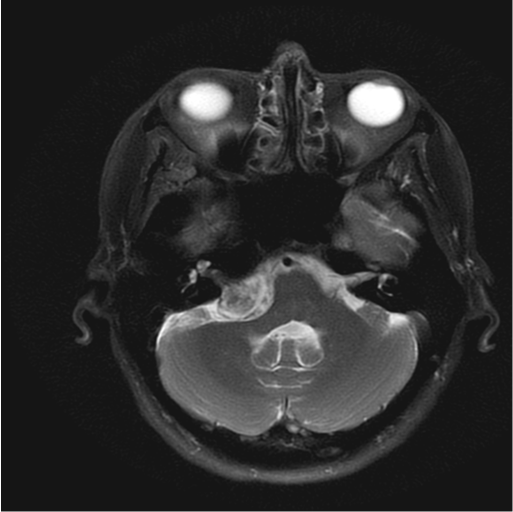 <p>Head MRI,&nbsp;T2 Cerebellopontine Angle&nbsp;(CPA)&nbsp;Tumor</p>