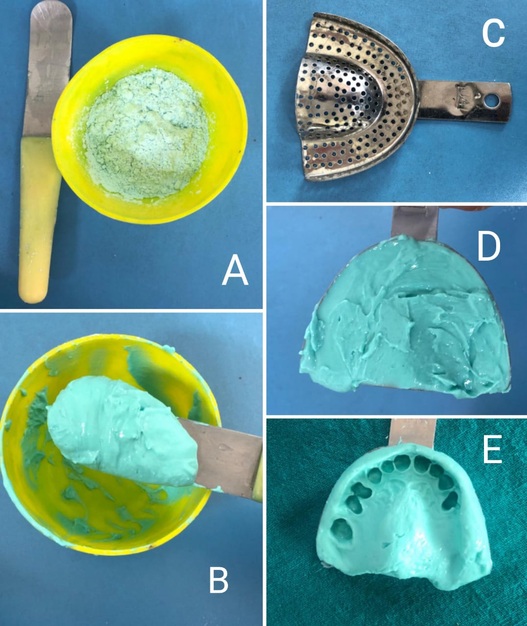 Mixing of alginate for impression making: A) Measured amount of alginate powder in flexible rubber bowl and a curved spatula,