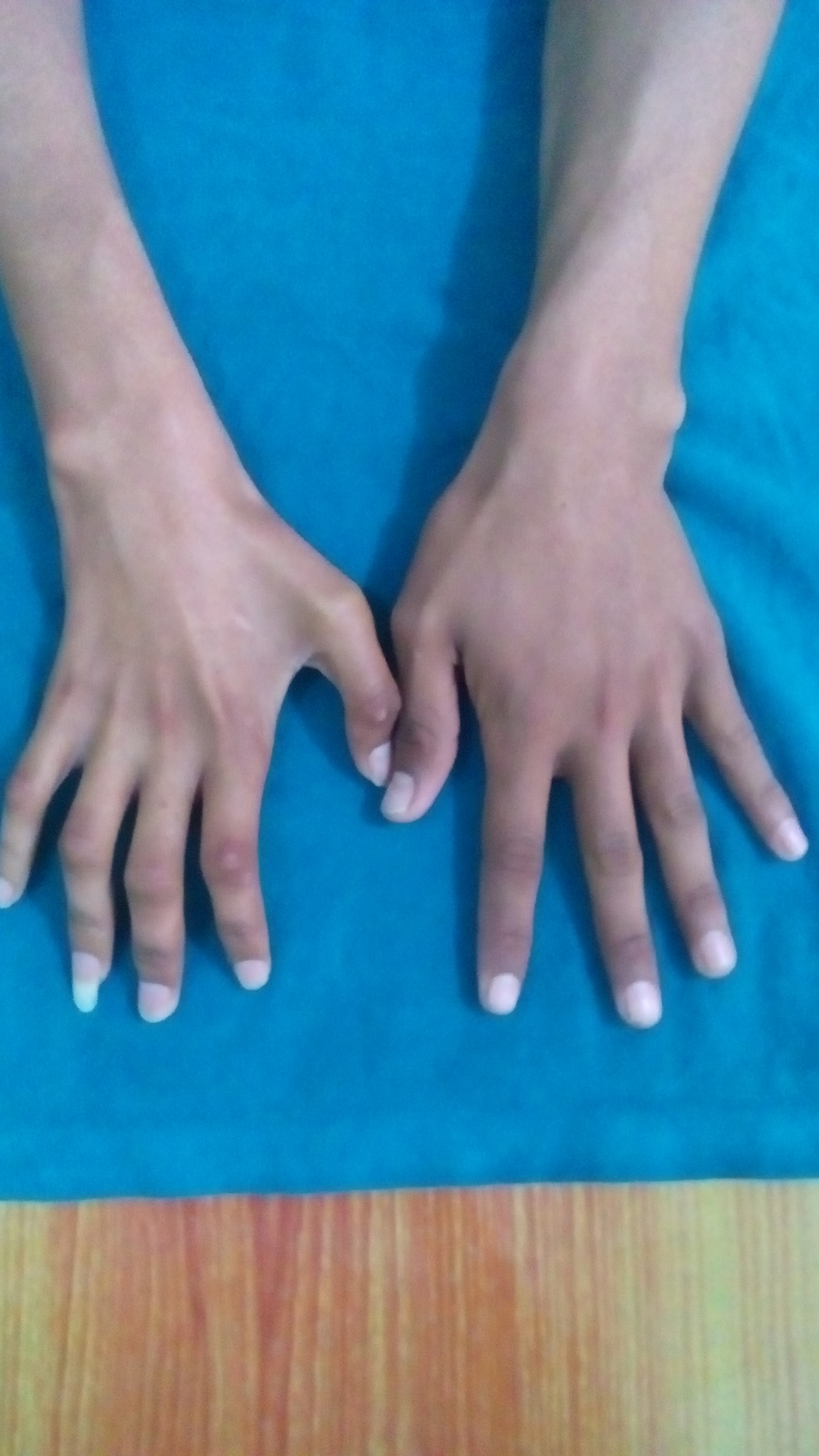 Claw hand in Hirayama disease