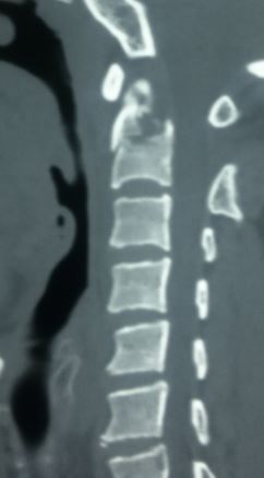 <p>Odontoid Fracture, Lateral. X-rays of the cervical spine include a lateral view of the fracture.</p>