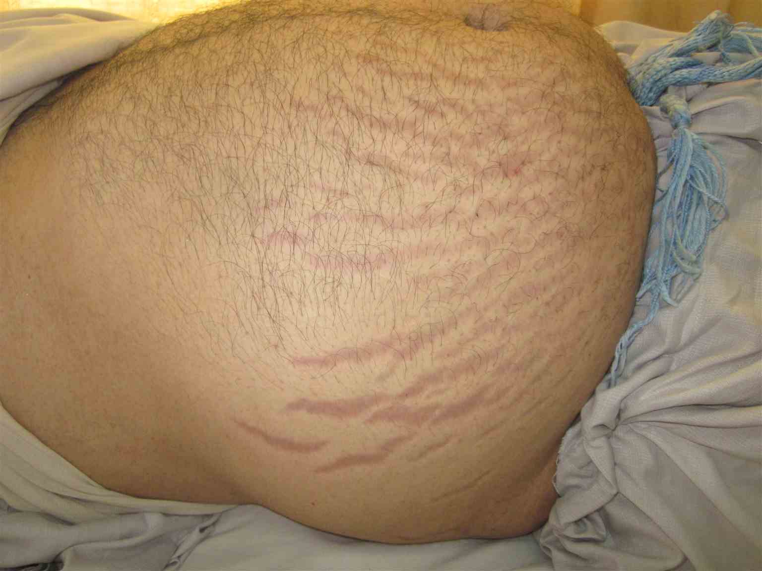 <p>Vertical Purplish Abdominal Striae in a Patient With Cushing Syndrome</p>