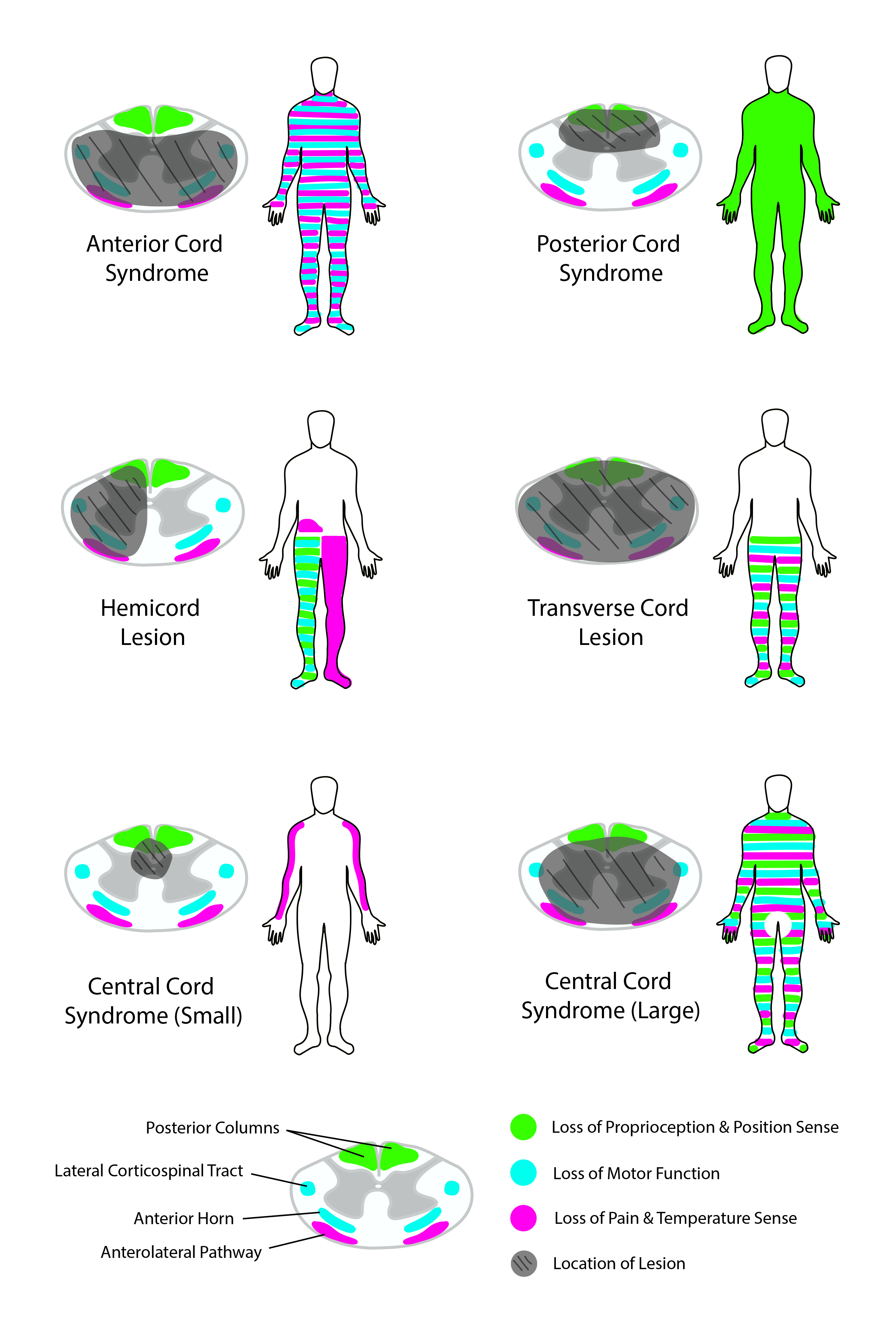 <p>Spinal Cord Syndromes. This image details common spinal cord syndromes and the neurological deficits they may cause.</p>