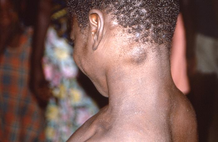 <p>Cervical Lymphadenopathy in a Child With Monkeypox</p>
