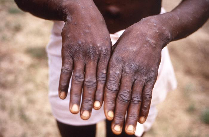 <p>Monkeypox Lesions on the Hands</p>