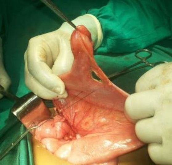 <p>Meckel Diverticulum With&nbsp;its Supplying Artery</p>