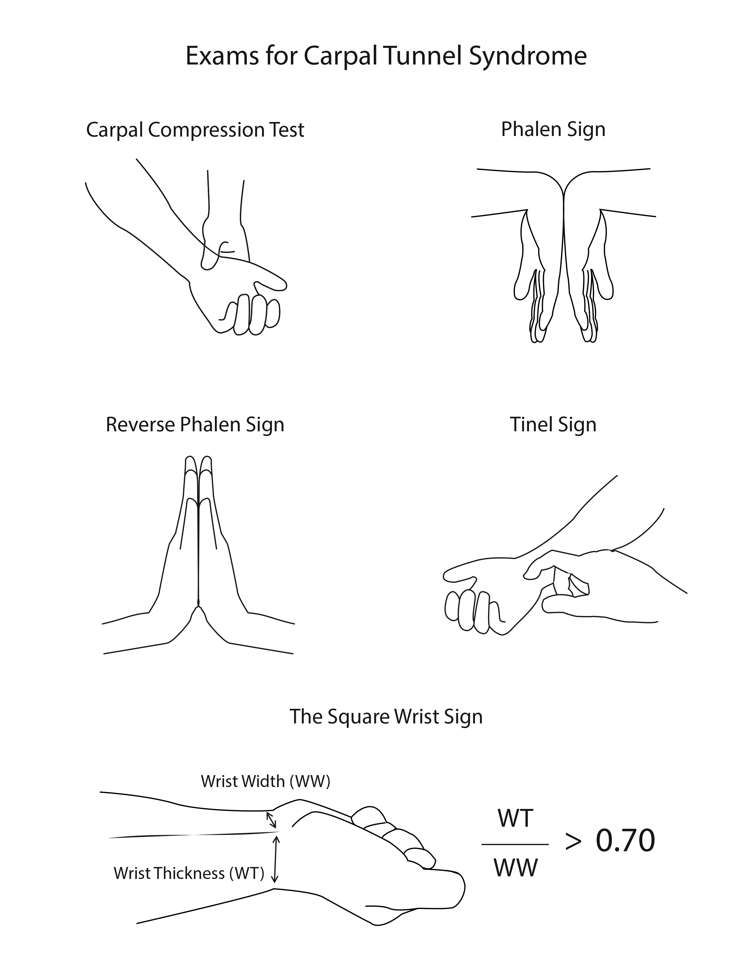 <p>Carpal Tunnel Physical Exam. The illustration depicts some maneuvers that test for carpal tunnel syndrome.</p>