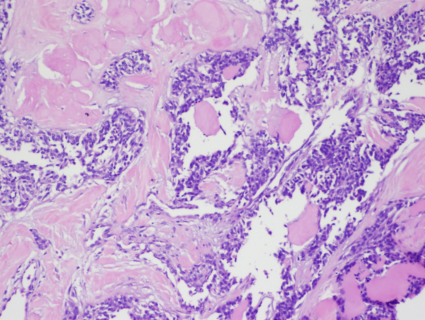 <p>Medullary Thyroid Carcinoma