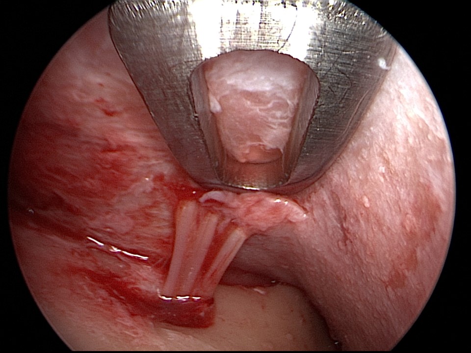 Endoscopic view of the supraorbital nerve as several of its branches emerge from a foramen