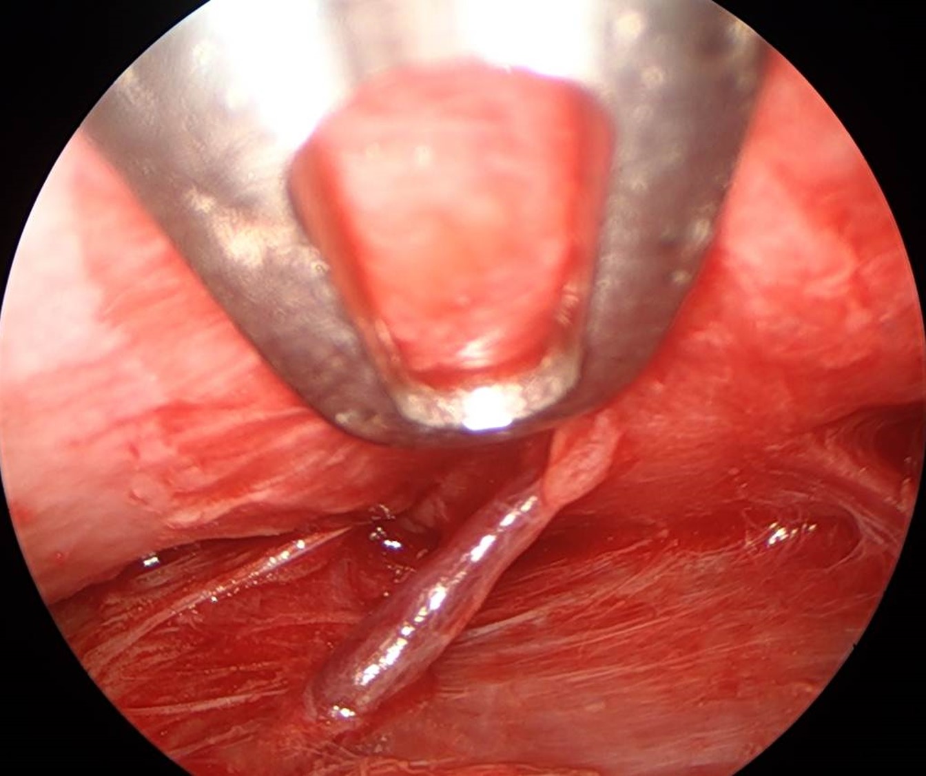 Endoscopic view of the medial zygomaticotemporal, or "sentinel," vein as it traverses the potential space between the temporalis fascia and the temporoparietal fascia, typically within 10 mm of the frontal branch of the facial nerve