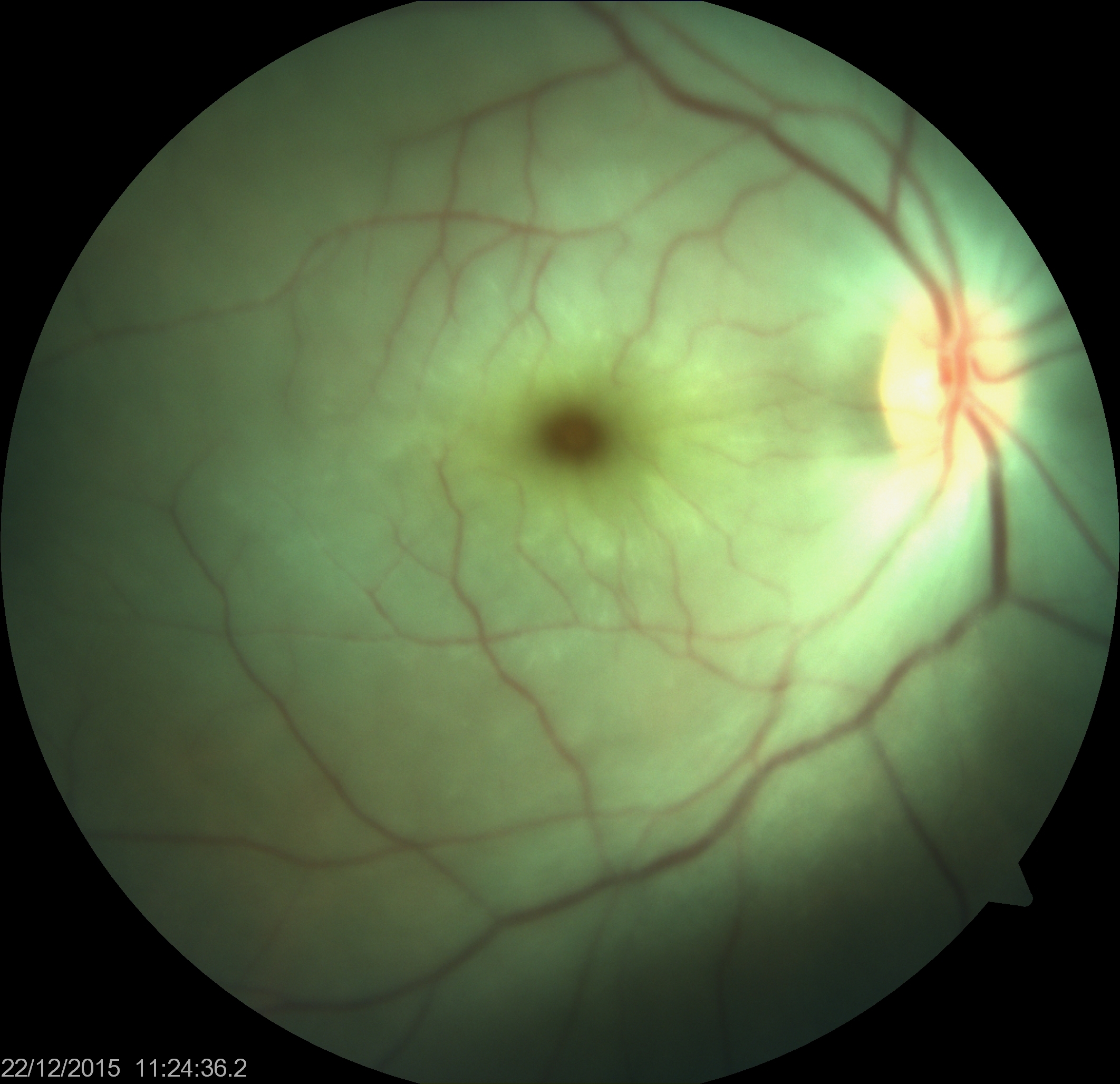 Central Retinal Arterial Occlusion- right eye