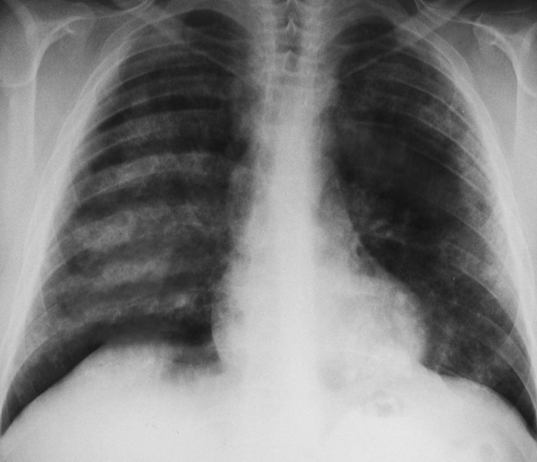 <p>Pulmonary Hemorrhages, Goodpasture Syndrome. Chest x-ray showing pulmonary hemorrhages seen in Goodpasture syndrome.</p>
