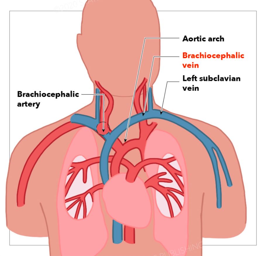 <p>Brachiocephalic Artery&nbsp;and Vein, Subclavian Vein, and Aortic Arch</p>